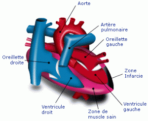 tumeur cerveau acouphene
