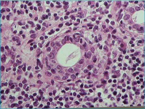 Facteur rhumatoide