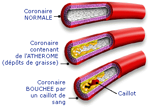 infarc-coronaire