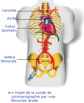 infarc0g