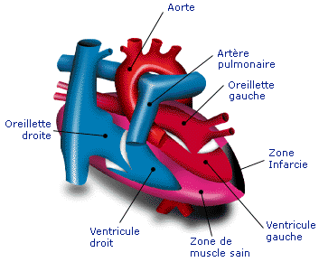 infarc2