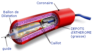 infarc3