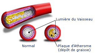 infarc4