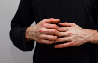 DYSHIDROSE : Démangeaisons, cloques, inconfort – Ce que vous devez savoir absolument