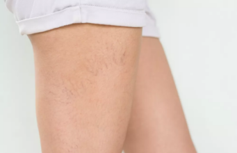 Varicosités : Ces petites veines qui tracent sur vos jambes – Ce qu’il faut vraiment faire varicosités